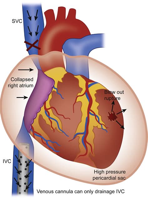 ruptured left ventricular